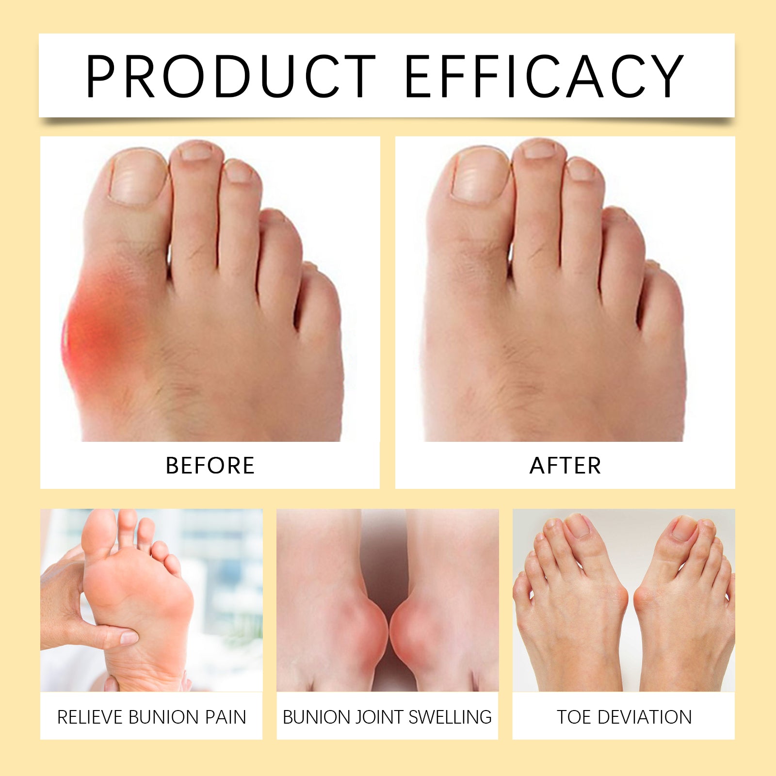 Ximonth Bee Venom Care Cream, Bee Venom Care Cream To Relieve Inflammation, Pain Swelling Can Improve Joint Health Bunions Adjuvant Therapy